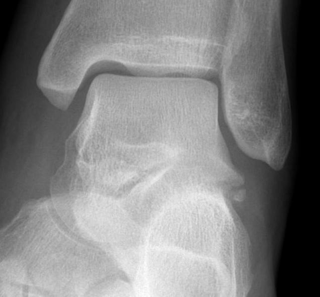 Lateral Process Fracture